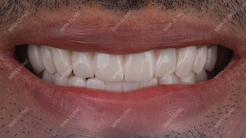 Zirconia Crowns